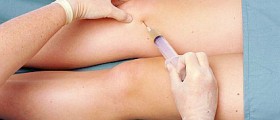 Arthrocentesis - Joint fluid aspiration
